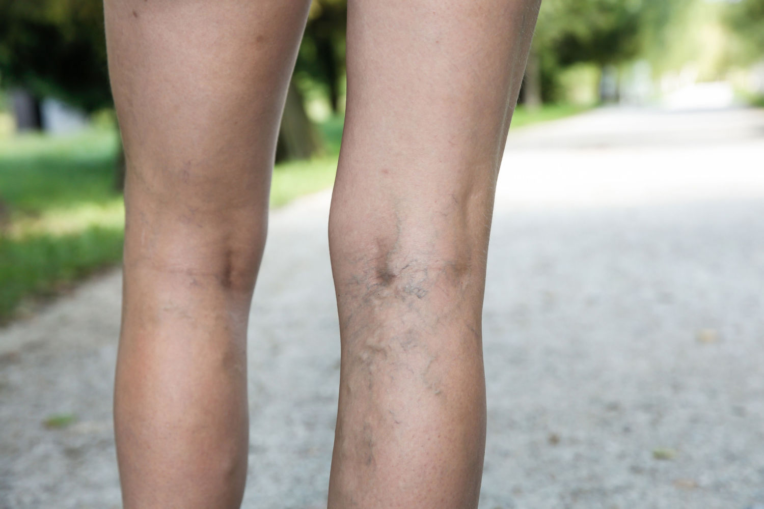 varicose veins on the back of a woman's legs, outside in a park on a walking path in Michigan