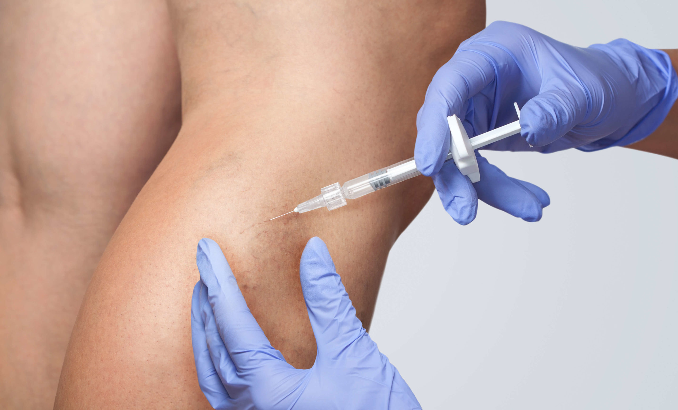 Sclerotherapy in Flint Michigan is a treatment for varicose veins and spider veins. This image shows a vein doctor injecting medication into a diseased vein.