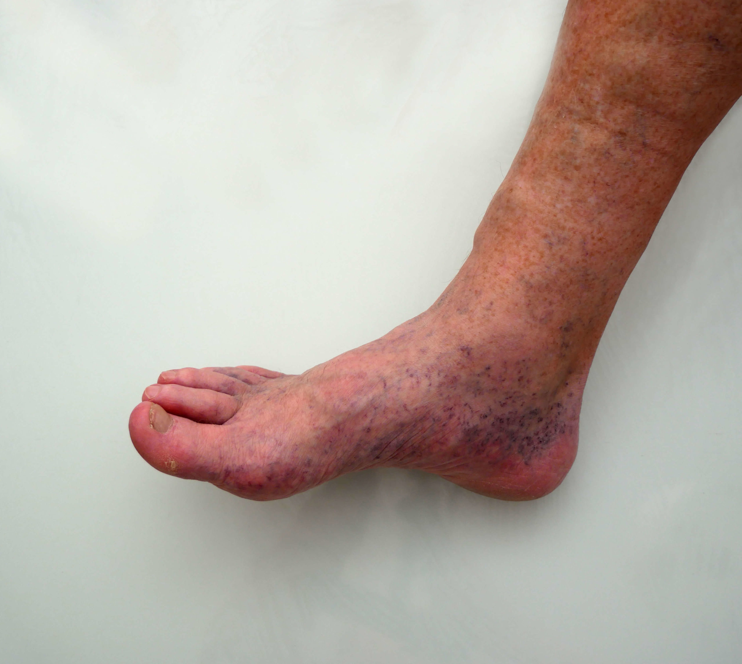 foot condition due to bad vein health