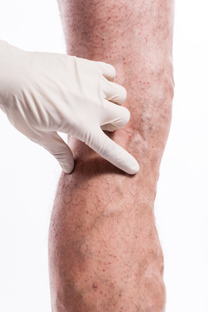 Leg with varicose veins - vascular surgeon is treating the veins in Flint, Michigan