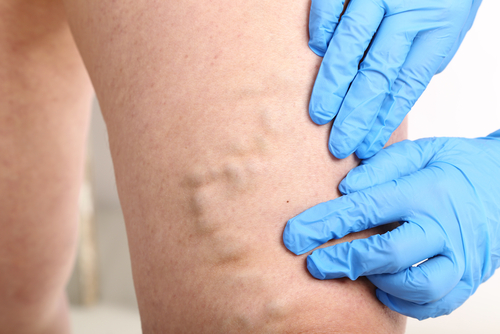 Microphlebectomy to remove varicose veins in Flint, MI