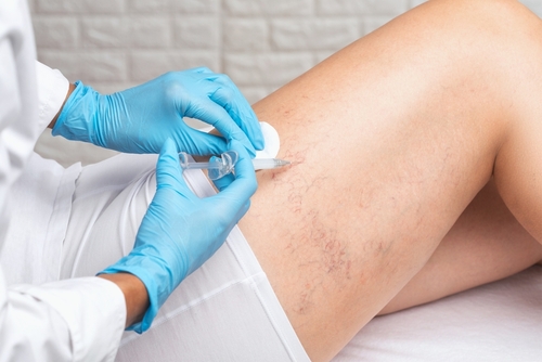 sclerotherapy injections to remove spider veins on thighs
