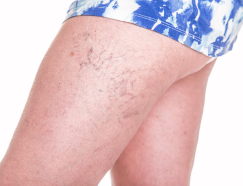 Tips To Get Rid of Spider Veins on Your Thighs