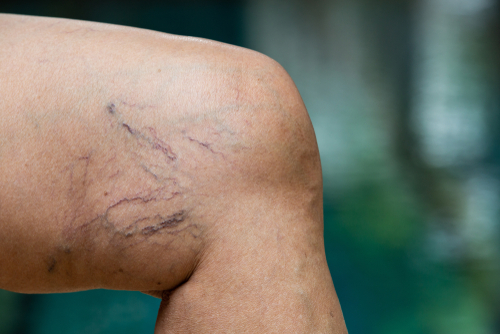 Image of spider veins on the back of a knee