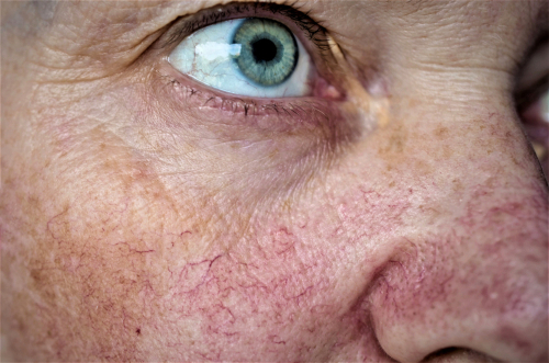 spider veins on the face and nose