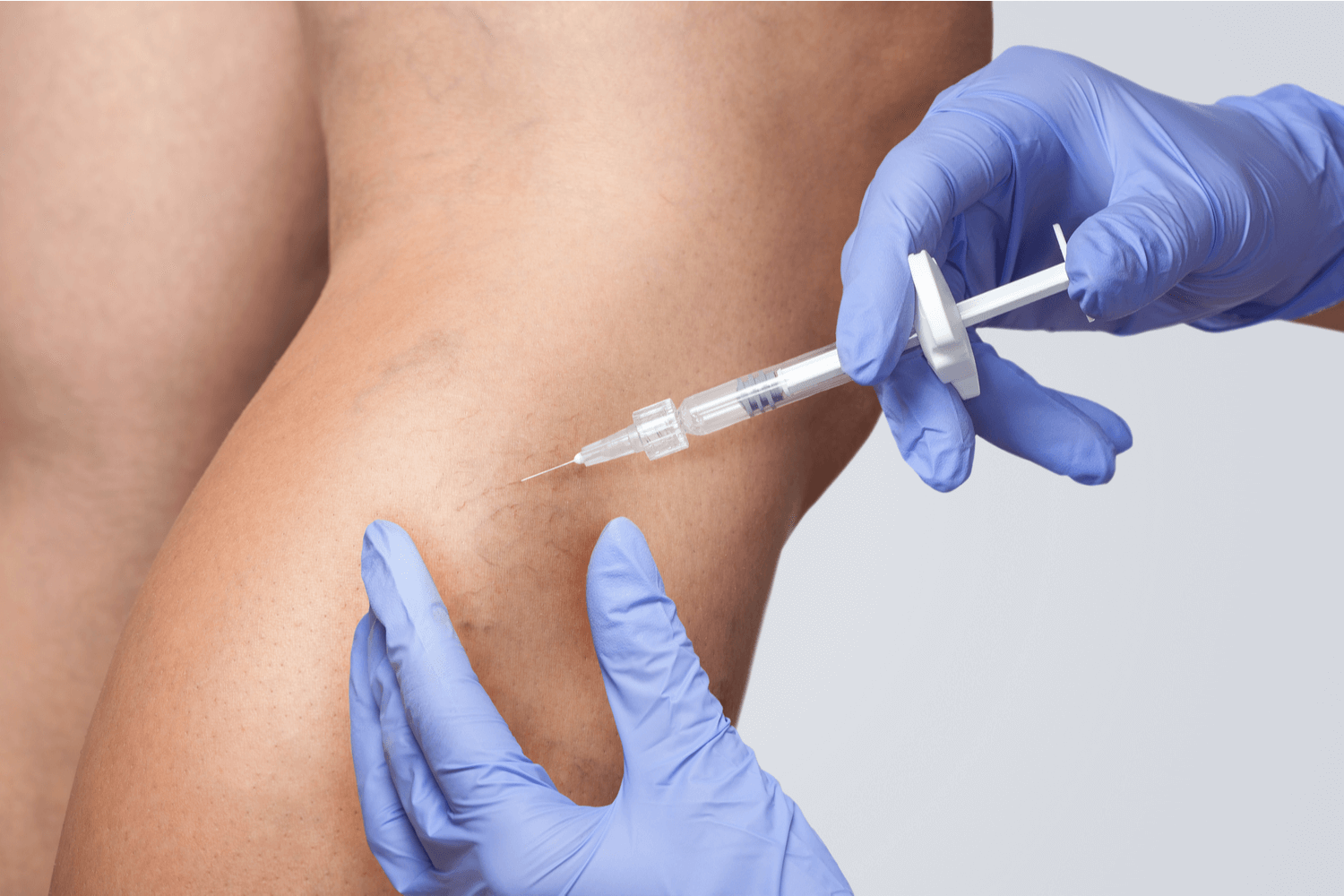 A doctor injecting sclerotherapy treatments for a spider vein patient
