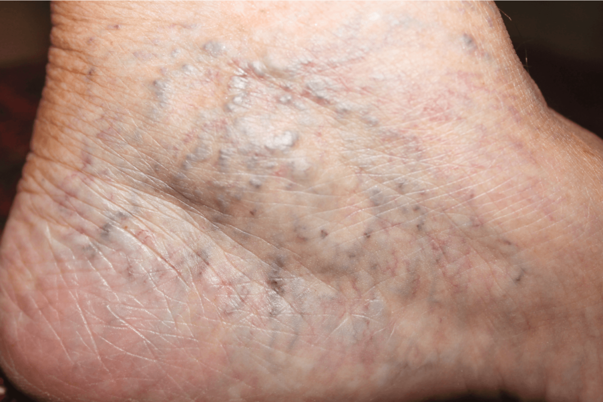 spider-veins-causes-and-treatment-veinsolutions-flint-mi