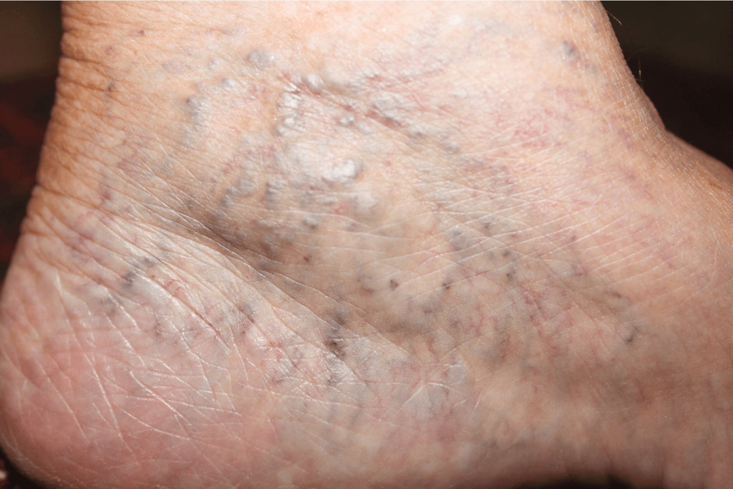 Spider veins visible around the ankles