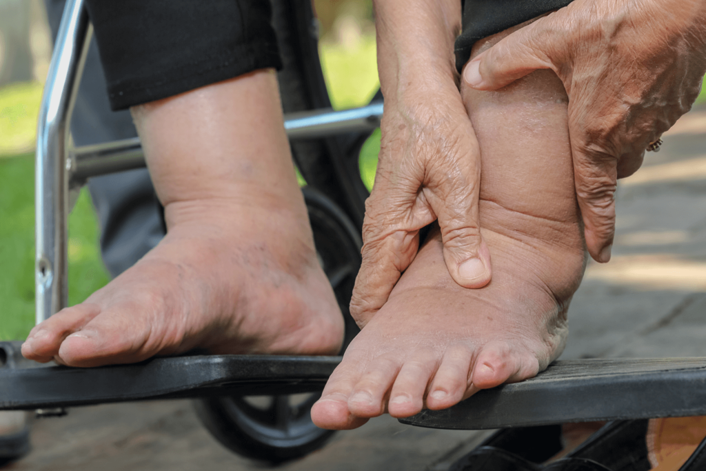 What is Chronic Venous Insufficiency?