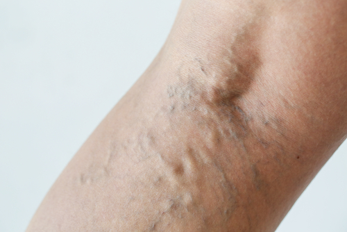 Reasons For Bulging Veins and What To Do