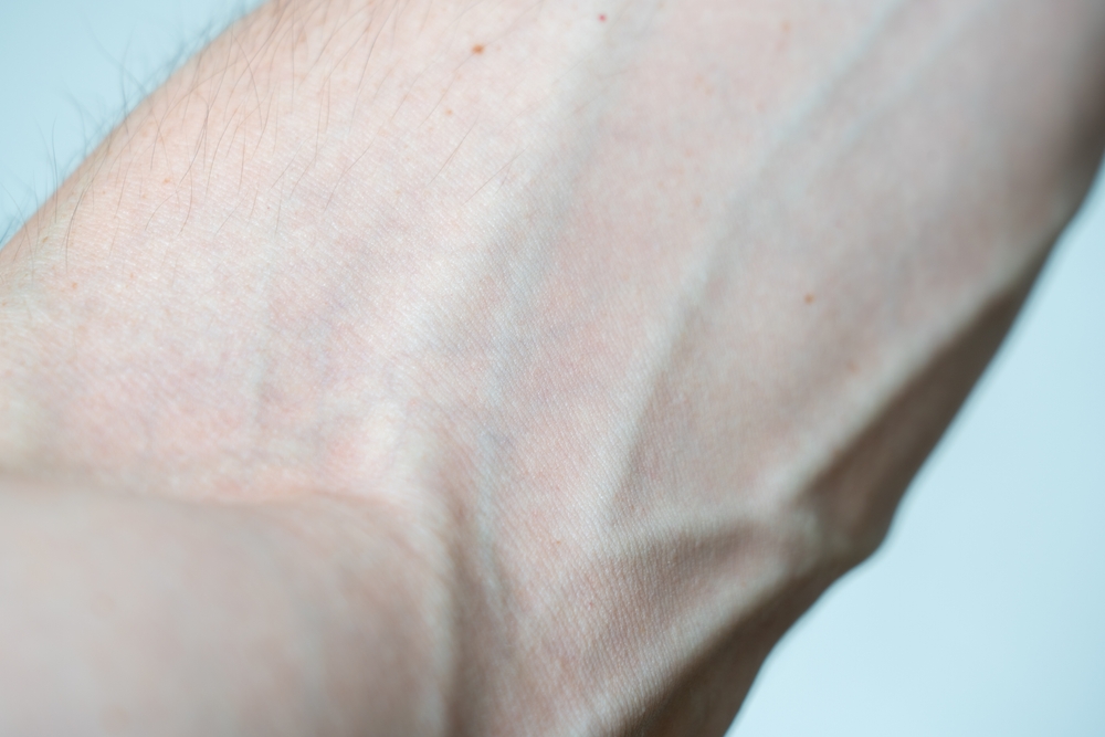 how-to-prevent-an-existing-vein-condition-from-worsening-with-time