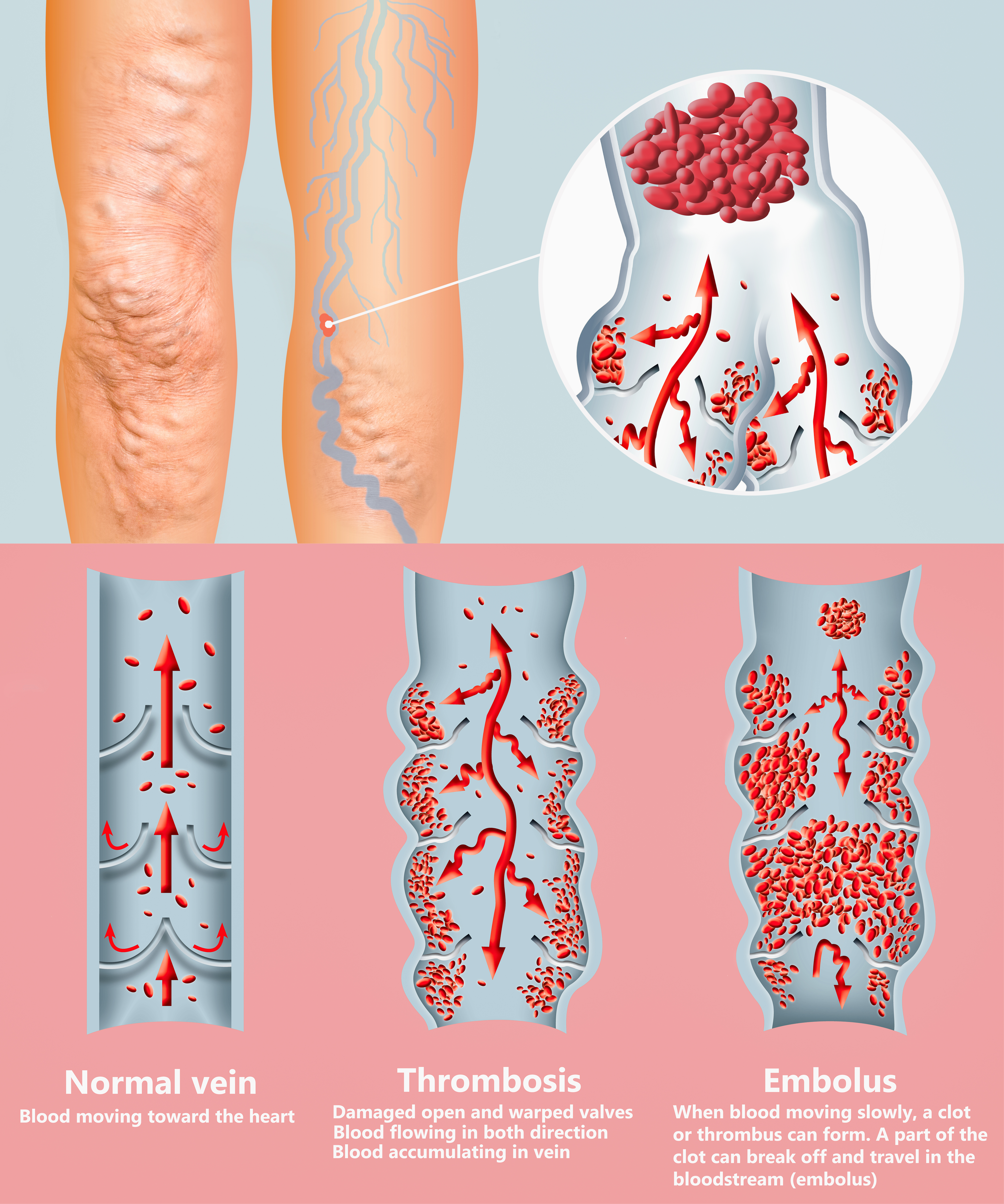 what is a blood clot diagram of embolus find treatment at veinsolutions