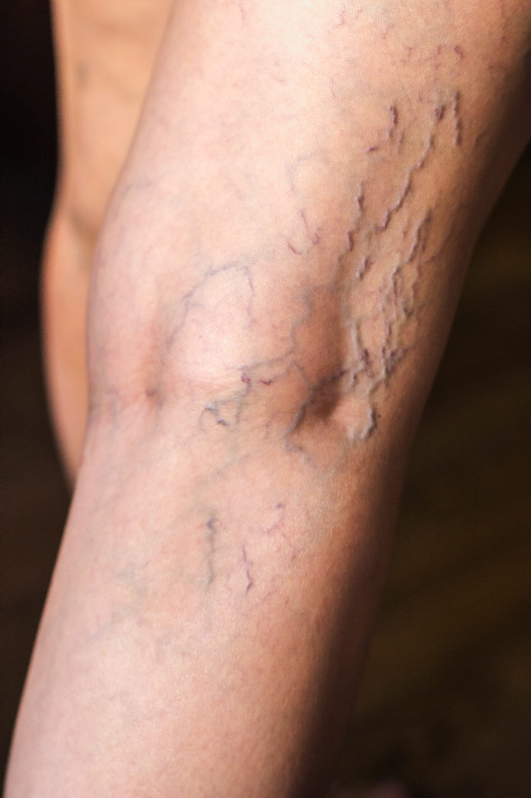 skin discoloration from vascular disease as spider veins and varicose veins