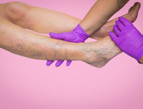 Can Chronic Venous Insufficiency Be Reversed?