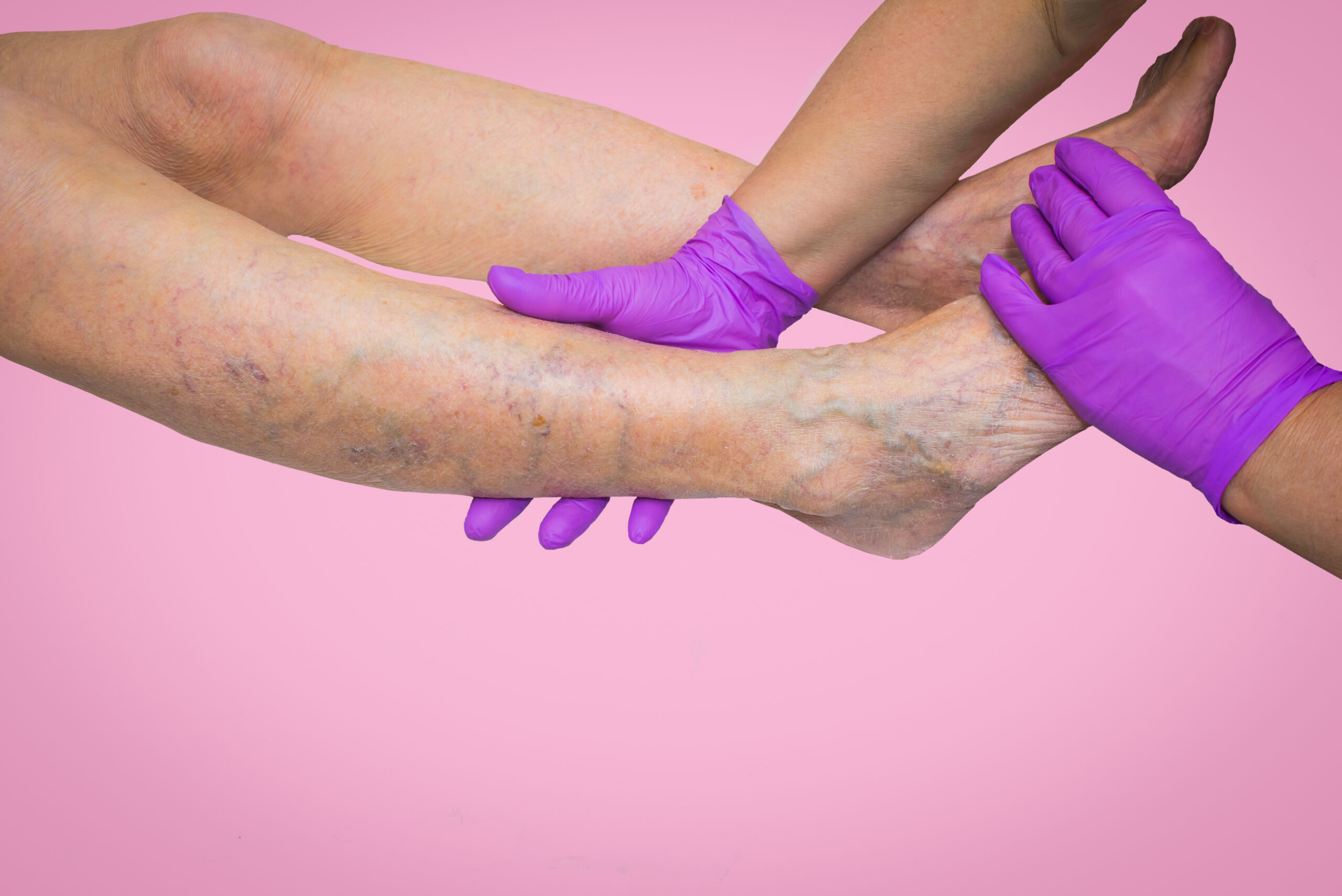 Doctor with purple gloves examines patient with varicose veins.