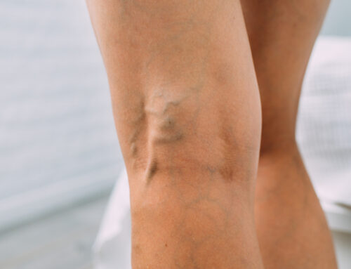 Are Varicose Veins Dangerous?