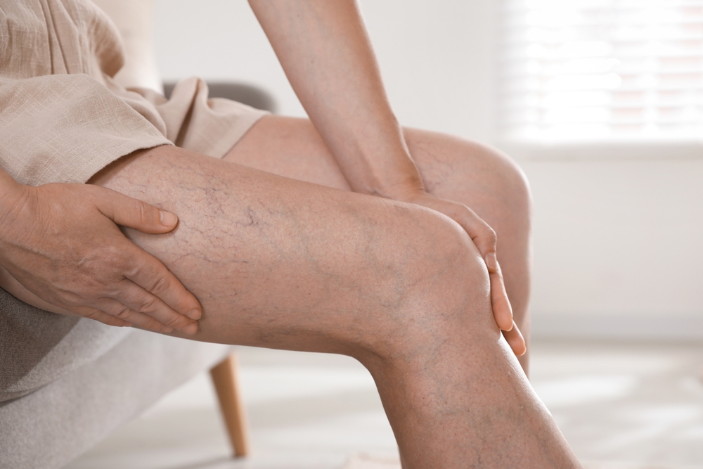 A woman with darkened veins on her legs.