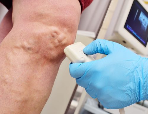 What Happens If You Don’t Treat Venous Disease? The Hidden Risks